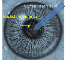 YAG-Laser Kapsulotomie zur Behandlung des Nachstars 